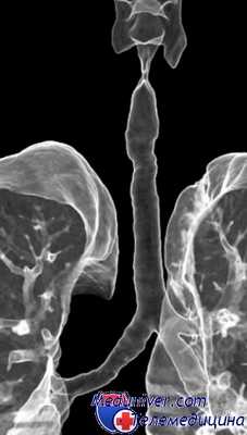 лечение травм трахеи и бронхов