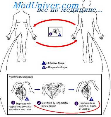 трихомониаз