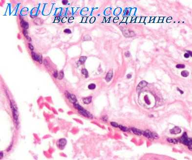 цитомегаловирусная инфекция