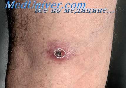 везикулезный риккетсиоз