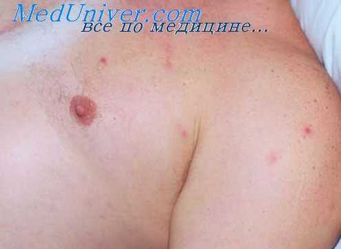 везикулезный риккетсиоз