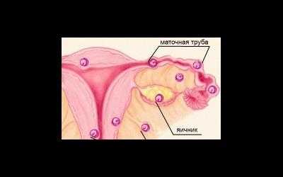 Трубная беременность