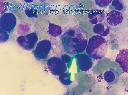 хантавирусная инфекция