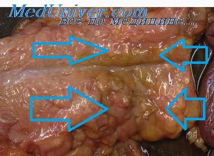 острый панкреатит