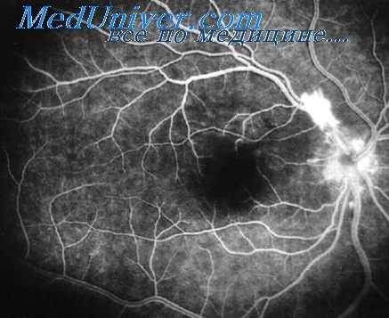 микроциркуляция при алкоголизме