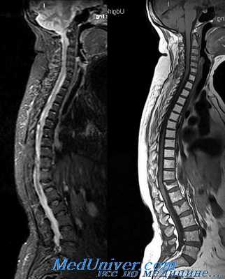 клиренс шейного отдела позвоночника