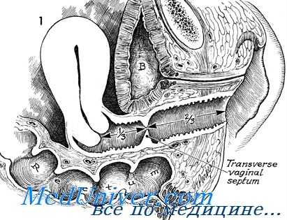 поперечная влагалищная перегородка и аплазия
