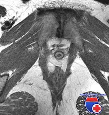 клиторомегалия