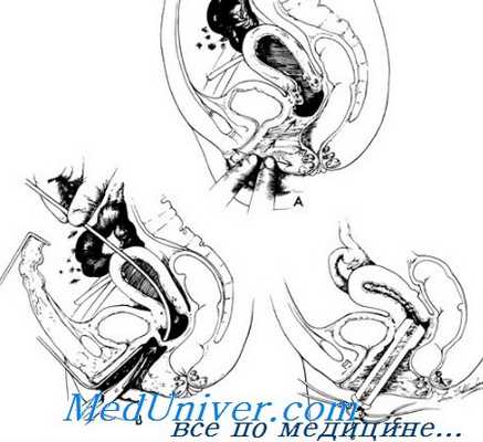 поперечная влагалищная перегородка и аплазия