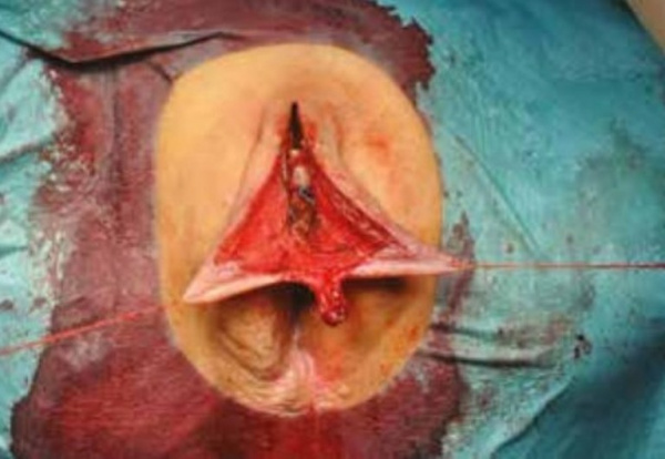 Клиторопластика