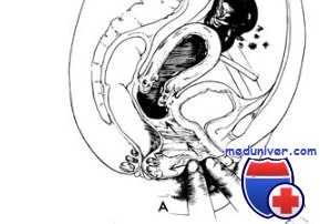 клиторомегалия