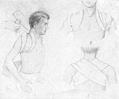 Рис. 4. Восьмиобразная повязка, накладываемая после репозиции при переломе ключицы: 1 — этап наложения; 2 — вид спереди; 3 — вид сзади