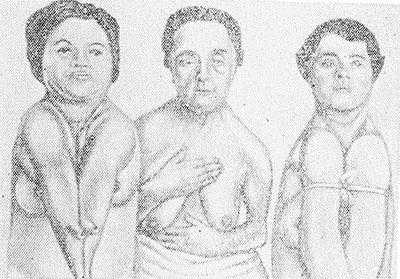 Рис. 1. Ключично-черепной Дизостоз (синдром Шейтхауэра—Мари—Сентона) у трех сестер. Отсутствие ключиц у двух сестер приводит к полному соприкосновению плеч.