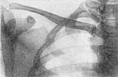 Рис. 2. Передняя рентгенограмма нормальной правой ключицы.