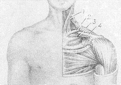 Рис. 3. Схематическое изображение типичного смещения отломков при переломе ключицы: 1 — грудино-ключично-сосцевидная мышца; 2 — внутренний отломок; 3 — подключичная мышца; 4 — наружный отломок.