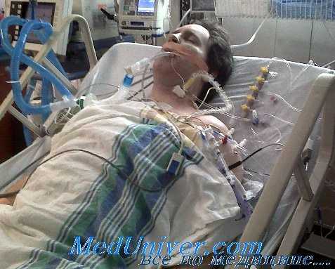 коагулопатия потребления