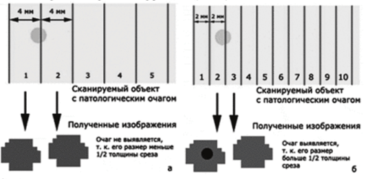Влияние толщины среза на выявление мелких очагов