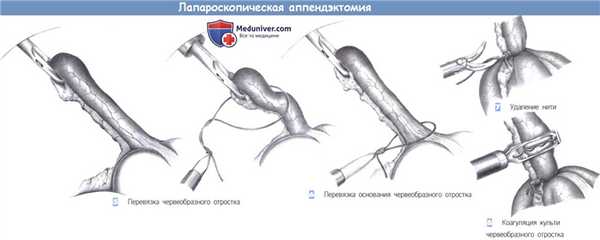 Этапы и техника лапароскопической аппендэктомии