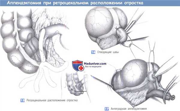 Этапы и техника операции при аппендиците - аппендэктомии