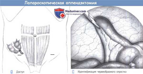 Этапы и техника лапароскопической аппендэктомии