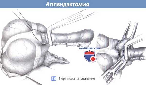Этапы и техника операции при аппендиците - аппендэктомии