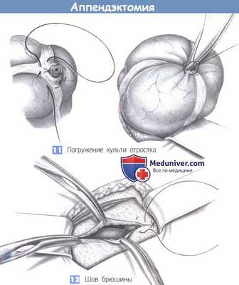 Этапы и техника операции при аппендиците - аппендэктомии