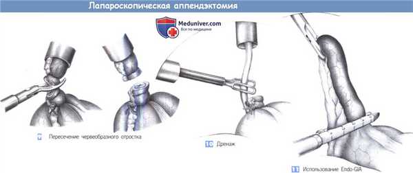 Этапы и техника лапароскопической аппендэктомии