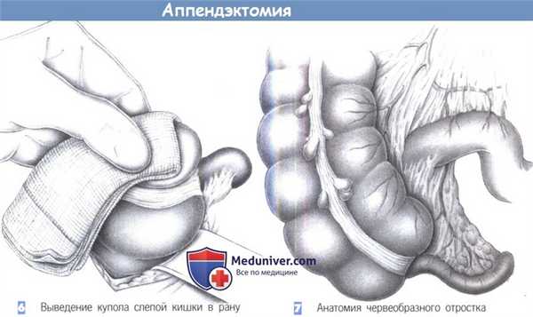 Этапы и техника операции при аппендиците - аппендэктомии