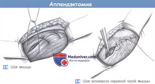 Этапы и техника операции при аппендиците - аппендэктомии
