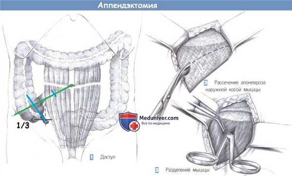 Этапы и техника операции при аппендиците - аппендэктомии