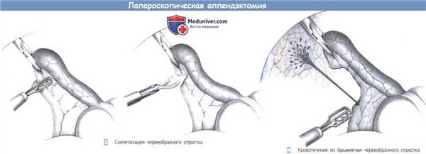 Этапы и техника лапароскопической аппендэктомии