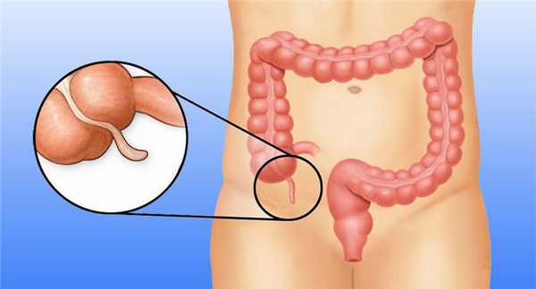 Аппендицит