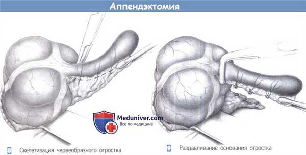 Этапы и техника операции при аппендиците - аппендэктомии