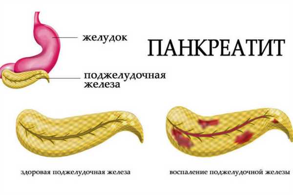 Панкреатит