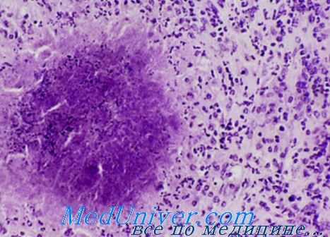 возбудитель коклюша - Bordetella pertussis