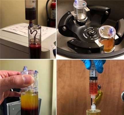 Стадии приготовления PRP-субстанции из крови пациента