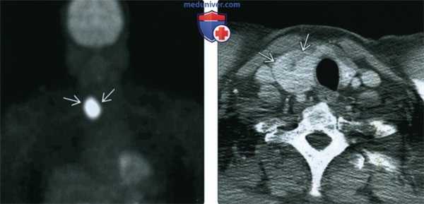 КТ, МРТ, УЗИ при аденоме щитовидной железы