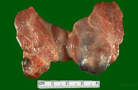В левой части щитовидной железы маленькая в правой большая коллоидная киста.