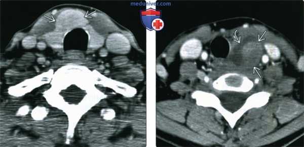 КТ, МРТ, УЗИ при аденоме щитовидной железы