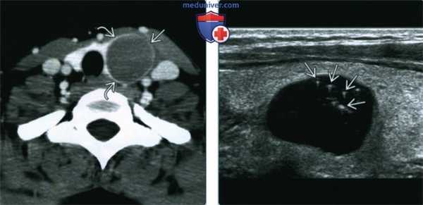 Коллоидная киста щитовидной железы - лучевая диагностика