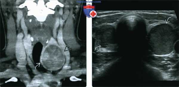 КТ, МРТ, УЗИ при аденоме щитовидной железы