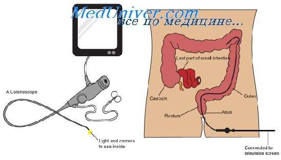 подготовка к колоноскопии