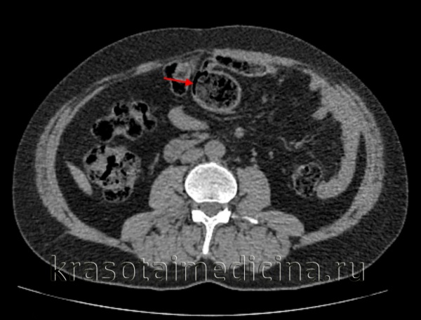 Пневматоз кишечника
