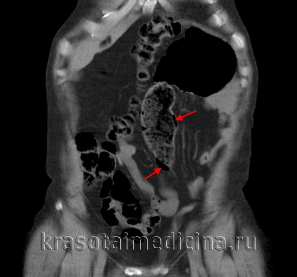 КТ ОБП. Пневматоз стенки сигмовидной кишки (этот же пациент).