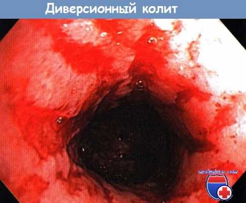 Колоноскопия при диверсионном колите