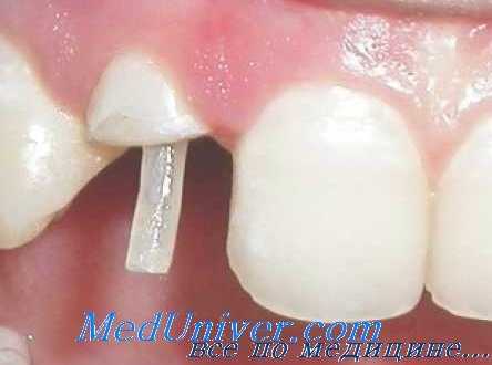 коронки на штифтово-культевой вкладке