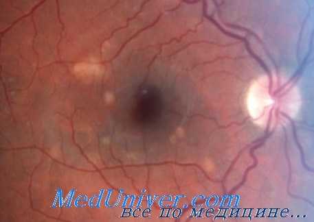 субмакулярные операции