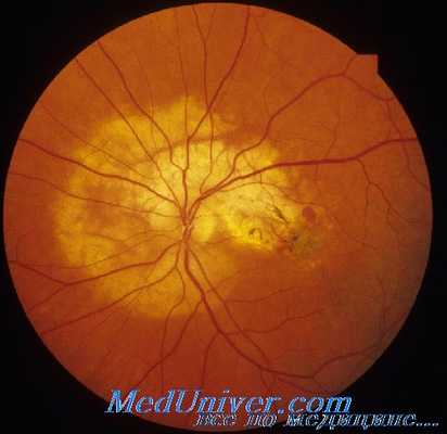 хориоидальные неоваскулярные мембраны