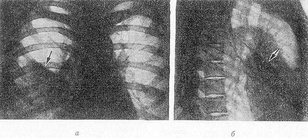 Рис. 1. Рентгенограммы грудной клетки в прямой (а) и правой боковой (б) проекциях при синдроме средней доли: тень пораженной средней доли указана стрелкой.