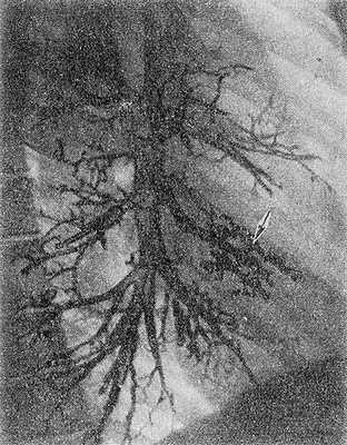 Рис. 2. Правосторонняя бронхограмма при синдроме средней доли (боковая проекция): бронхи средней доли (указаны стрелкой) сближены, деформированы, цилиндрически расширены но типу бронхоэктазов.